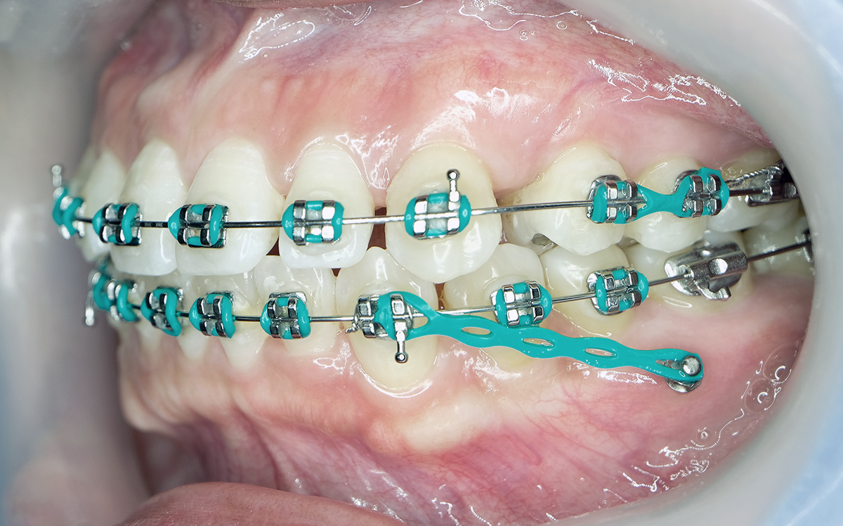 TADs Mini Implants Mini Screws Orthodontics by Jackie